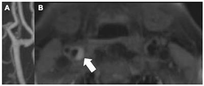 The role of cross-sectional imaging of the extracranial and intracranial vasculature in embolic stroke of undetermined source